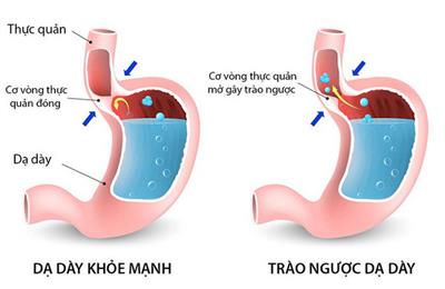 11 triệu chứng trào ngược dạ dày thực quản hay gặp phải