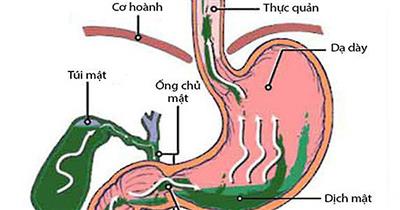 Trào ngược dịch mật là gì ? Bệnh nguy hiểm đừng chủ quan