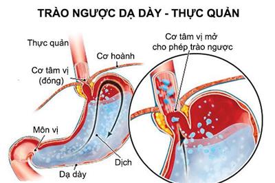 Bệnh trào ngược dễ gây ung thư thực quản